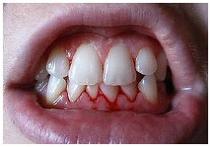 Bleeding Gum Treatment